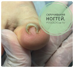 скручивающейся загибающийся ноготь